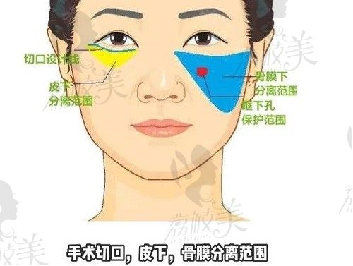 武汉艺星徐国建杜莎眼袋切口中面部提升2万元起,眼袋+面部松垂全消失