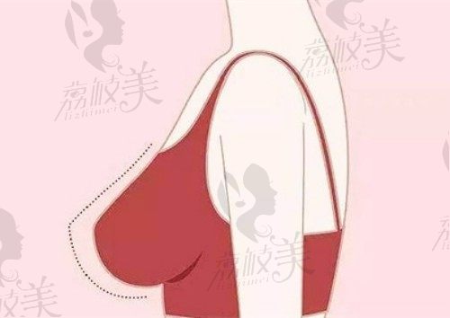 南京美莱夏建军做24小时极速隆胸手术效果自然，改善胸部大小不一
