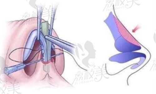 上海艺星隆鼻价格表公布，看看艺星隆鼻怎么样&哪个医生技术最好