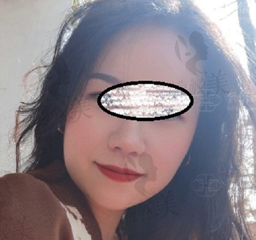 深圳李信锋做鼻子图片分享,来自短鼻/鼻基底凹陷的拯救攻略！