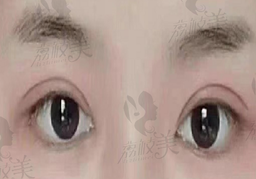 宁波美莱喻正虹医生做眼修复是真的好，做完后拥有灵动自然双眼皮