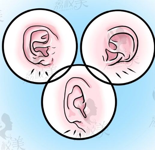 北京小耳畸形矫正一、二、三期手术费用公布，附耳再造资质医生名单