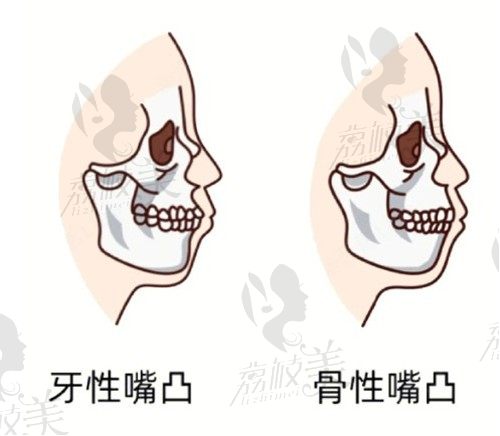 南京成人龅牙矫正牙齿多少钱，南京凸嘴手术好的医院价格已公布