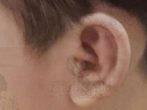 北京丽都耳畸形整形只要2w多，自体肋软骨直埋法再造活力真耳朵