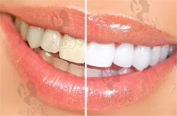 冷光美白牙齿可以白到啥程度？它和皓齿美白有什么区别，看价格就知道了