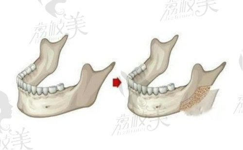 重庆当代安可忍做下颌角技术好，长曲线磨骨仅需22800元起