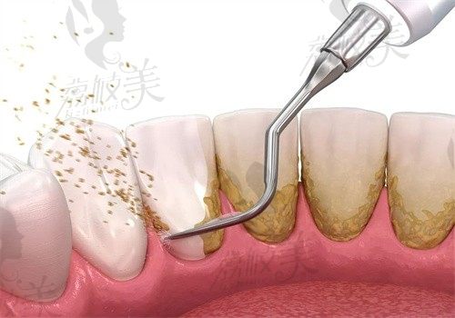 超声波洁牙和喷砂洁牙的区别是啥？还想知道洗牙对牙齿到底好不好