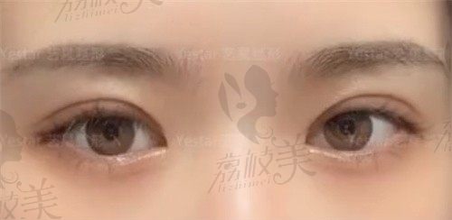西安艺星整形做的单眼皮变双眼皮，宋蔚医生6D隐痕双眼皮术后好满意