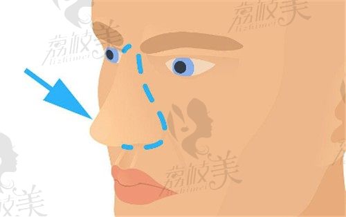 上海鼻头整形医院哪家好，做鼻头美容手术多少钱