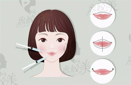 m唇手术是恒久的吗？通过原理和成效看看做m唇手术能维持多久