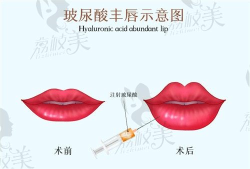 嘴巴丰唇有几种方式？分析自体脂肪填充丰唇和玻尿酸丰唇的区别