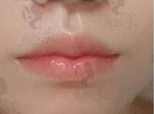 上海厚唇改薄手术多少钱？上海各大正规整形医院厚唇改薄价格参考