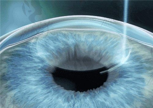 从广州英华眼科简介判断眼科做近视手术正规的很,技术价格全分享