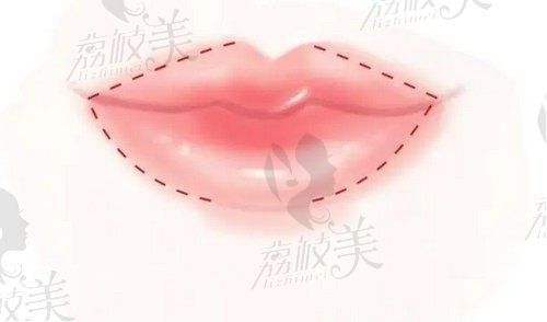 都说嘴角上扬的女人面相好，上海嘴角上扬手术好的医院有哪些？