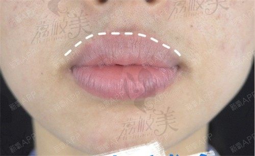真实的M唇手术前后对比照给你参考，分享我做M唇手术过程和经验
