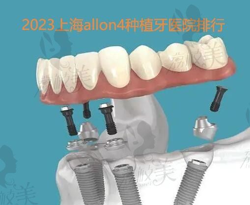 2023上海allon4种植牙医院排行列出（上海半口\全口价格一览表）
