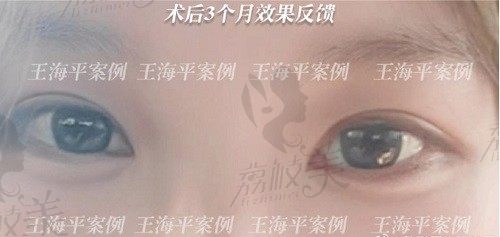 武汉卓美王海平宽深假肉条感双眼皮修复+祛眼袋反馈,术后秒变星星眼