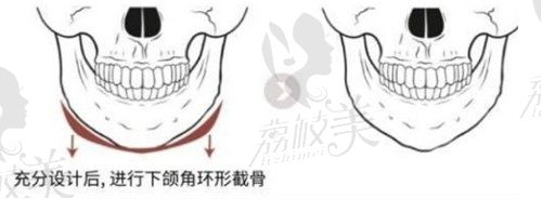 上海华美李志海做长曲线下颌角技术牛，方圆脸变小v脸好喜欢