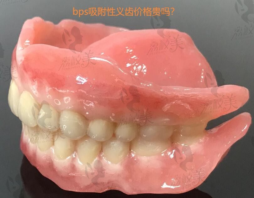 bps吸附性义齿价格贵吗？半口及全口吸附性义齿收费价格在线查