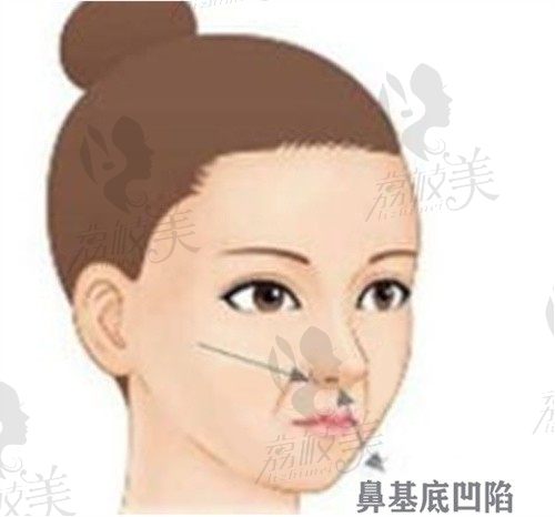 西安美莱曾熬膨体填充鼻基底价格1.2w起，可改善鼻基底凹陷和塌鼻子