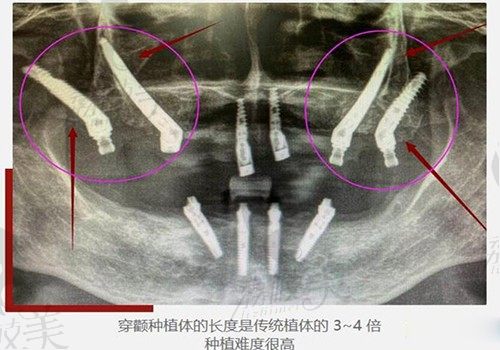 杭州西湖口腔医院种植牙价格不贵，因为落地了集采单颗收费2980起