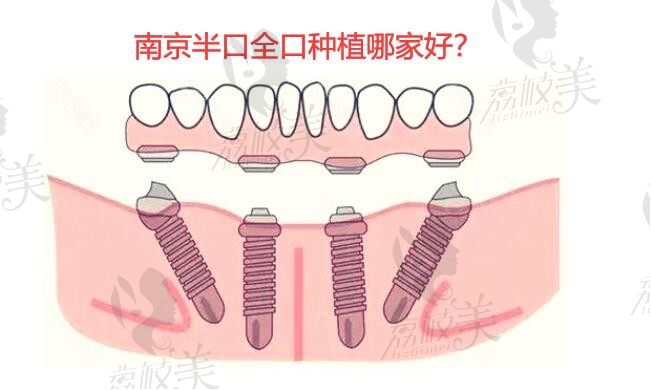 南京半口全口种植哪家好？排名前十中南京金铂利口腔种植牙便宜技术好