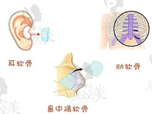 广州中家医找易普锋做肋软骨隆鼻，术后鼻子真的好自然
