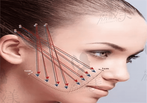 埋线提升面部可以维持多久?来看维持时间/注意事项/手术价格