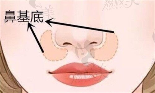 北京联合丽格鼻基底凹陷填充技术好，人工骨鼻基底假体填充价格揭晓