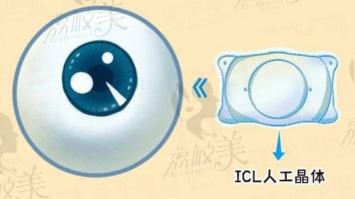上海和平眼科翟爱琴icl晶体植入手术技术好，2.9w元起恢复正常视力