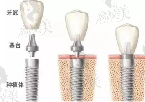 种植牙一共有几期手术？想知道种植牙第一步打孔很痛苦吗