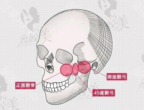 郑州赵绛波磨骨整形实力超强的，非常可信的下颌角整形仅2.5W元起