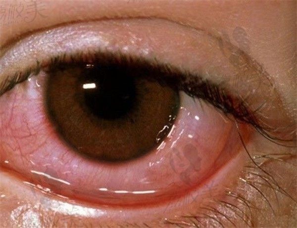 结膜炎是什么原因引起的，拖久了会导致眼睛失明吗