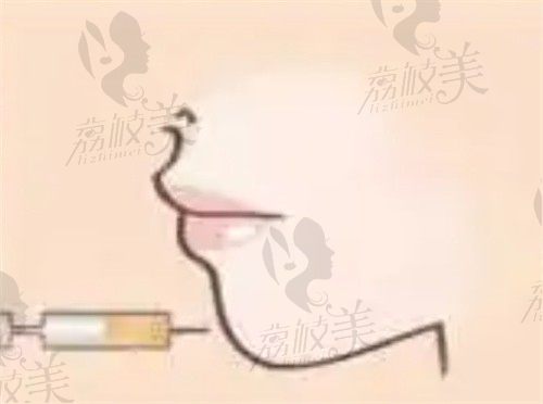 全科普:下巴玻尿酸填充多少钱？看能维持多久,副作用及注意事项