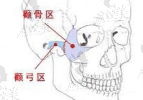 颧骨颧弓内推加下颌角截骨真的会脸部下垂吗？来看详情解密