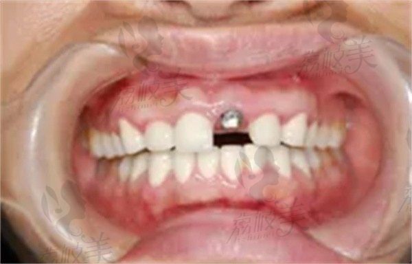 种植牙后牙龈发炎能热敷吗？想问问种植后牙龈肿痛多久能好