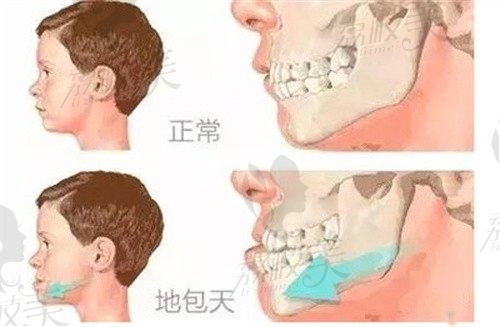 二十几岁地包天矫正来得及吗？从地包天矫正方式来看完全来得及