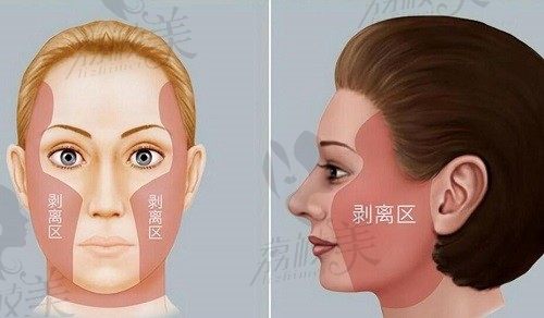 面部拉皮手术多大年龄适合做?35,40,50,60岁适应的拉皮方式有不同
