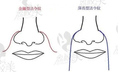 法令纹可以填充玻尿酸吗价格多少钱？一般需要注射几支玻尿酸