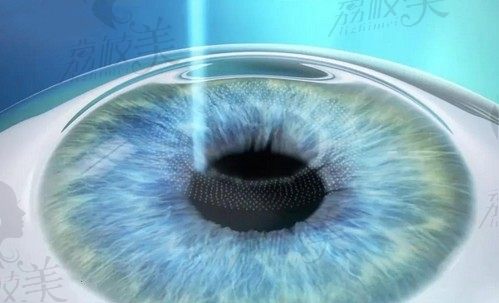 上海新视界眼科医院张晓琳做全飞秒激光手术很靠谱，价格1.8w元起