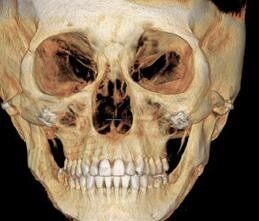 韩国颧骨修复好的吴铭埈占一个,中面部颧骨缩窄6.6W起状态绝了