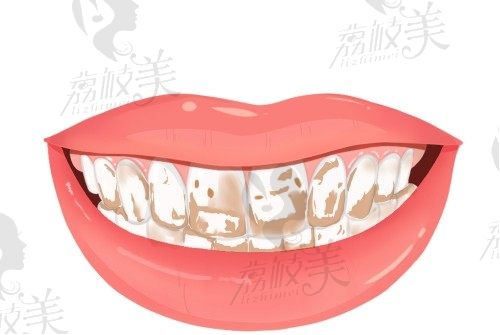 色素牙治疗需要多少钱一颗?现在广州广大口腔色素牙美白650元起不贵