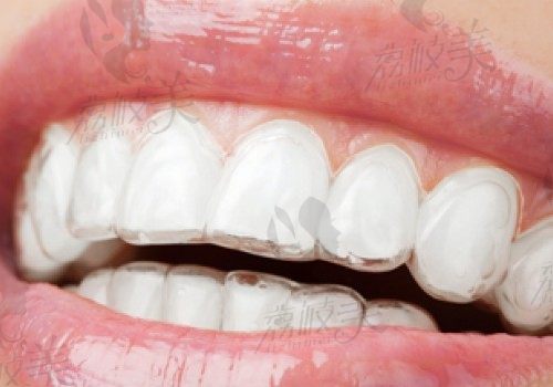 矫正牙齿后保持器要戴多久？又要多久更换一次呢？