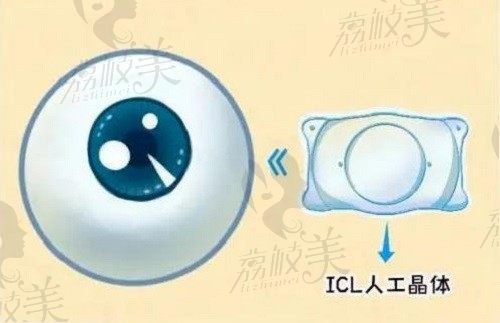 上海爱尔眼科医院icl晶体植入价格3w起，毛凯波技术可靠睛彩万分