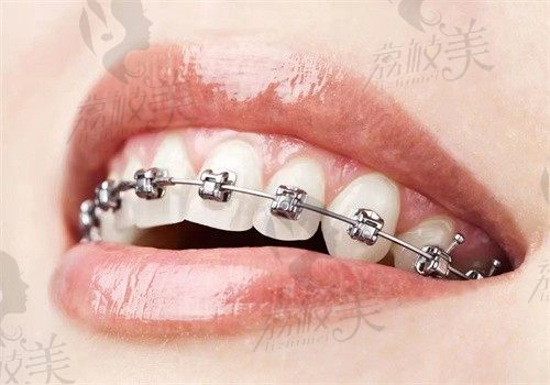 天津中诺牙齿矫正多少钱？找张少民医生做金属托槽8千起效果超棒