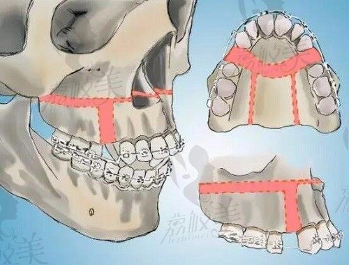 上海高伟正颌手术技术厉害,骨性凸嘴正颌手术价格6万元起