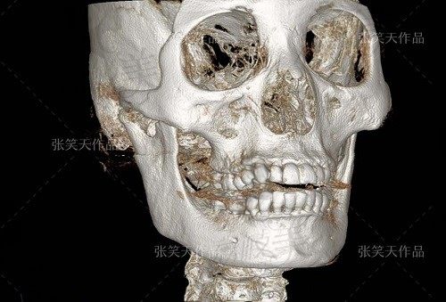 北京圣嘉新面部轮廓整形推荐张笑天，上下联合磨骨手术仅需10w起