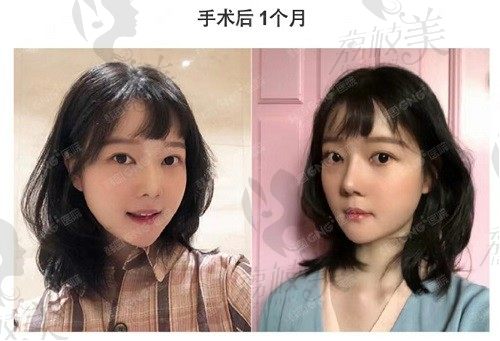 手术后