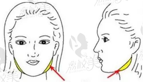 武汉亚韩赵贵庆改脸型技术优势揭秘，长曲线下颌角磨骨价格48000元起