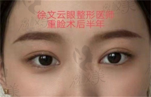 西安徐文云双眼皮修复口碑实例反馈+2023价格表攻略,眼整形技术真的好